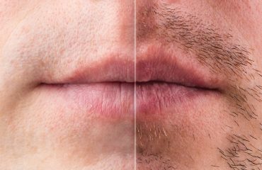 The result on the mans face after shaving, before and after. Effect of after shave cream. Hair transplantation on the beard. Close-up