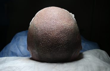 hair transplantation with dhi technique