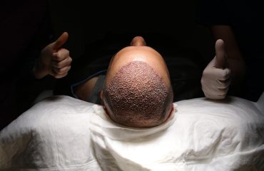 Hair transplant patient in the end of the operation